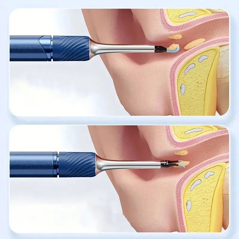 Waterproof Smart Ear Wax Removal Cleaner Kit (HD 360° Visual Experience)
