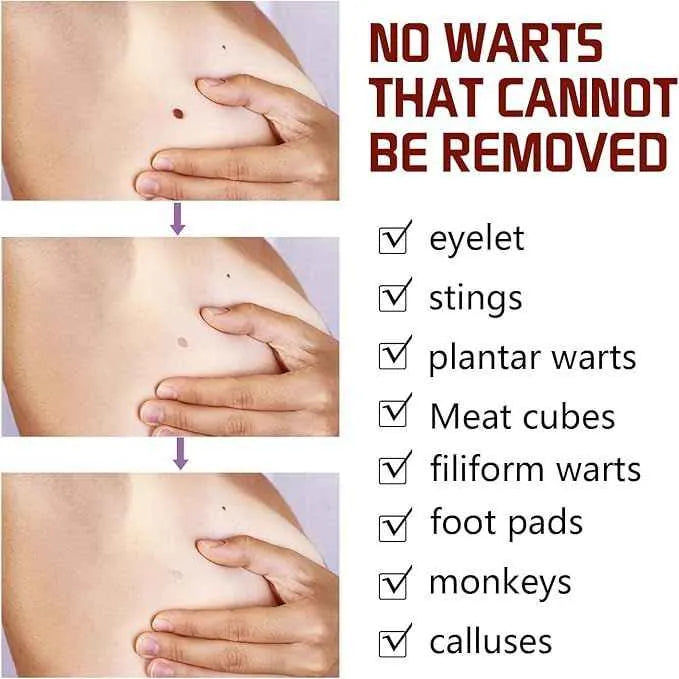 Tags and Moles Remover For All Skin Types