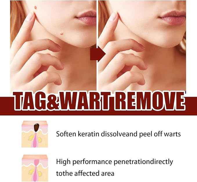 Tags and Moles Remover For All Skin Types