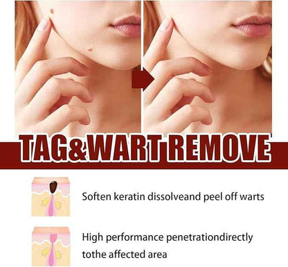 Tags and Moles Remover For All Skin Types