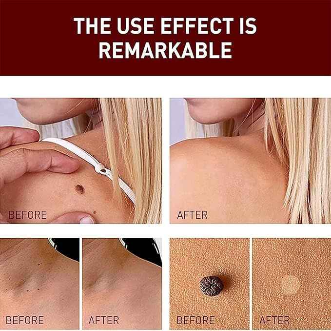 Tags and Moles Remover For All Skin Types